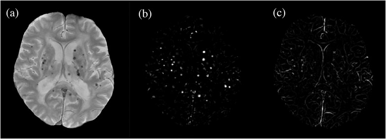 Automated Detection of Cerebral Microbleeds on Two-dimensional Gradient-recalled Echo T2* Weighted Images Using a Morphology Filter Bank and Convolutional Neural Network.
