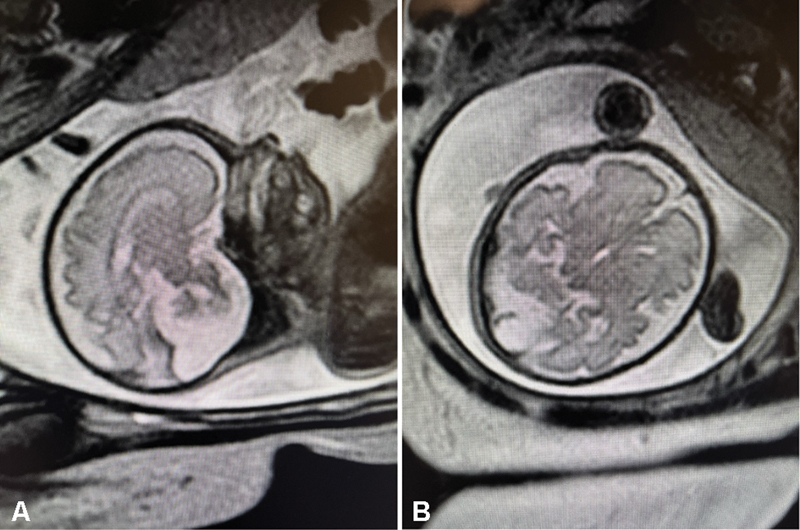 Infant with Known Dandy-Walker Malformation and Poor Feeding Found to Have Additional Diagnosis.