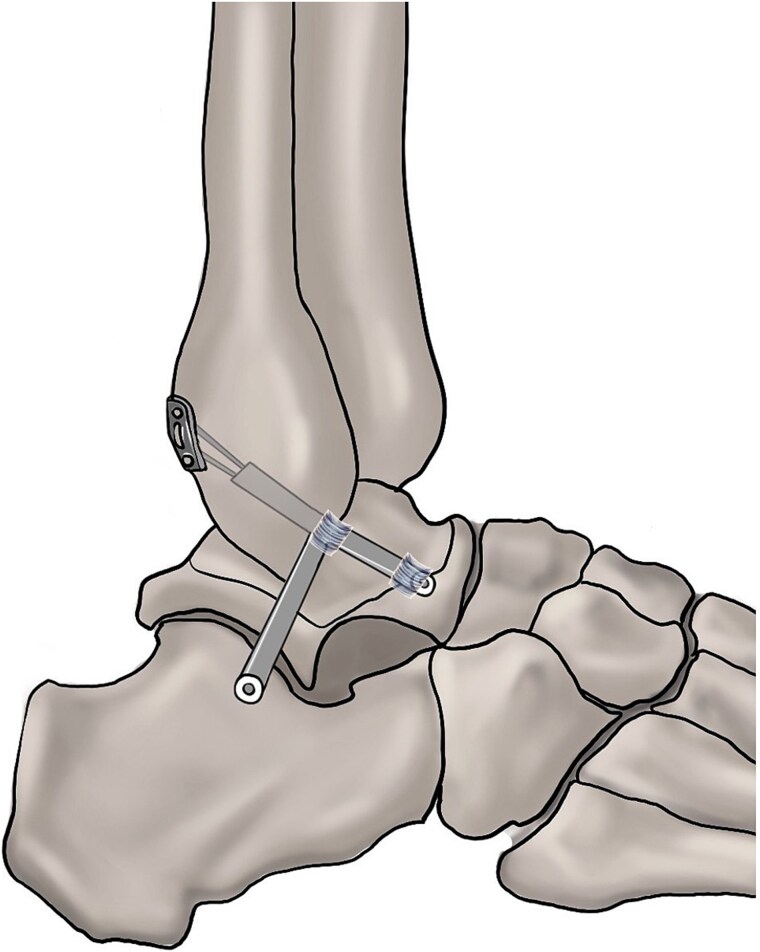 All-inside arthroscopic procedures for chronic lateral ankle instability: evidence-based clinical practice guidelines.