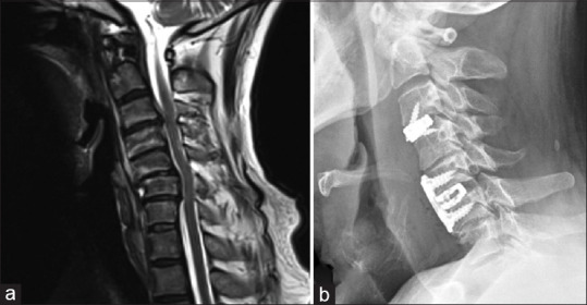 Contiguous versus skip discectomy and fusion in cervical disc herniation: Do we need to fuse the normal intermediate segment?