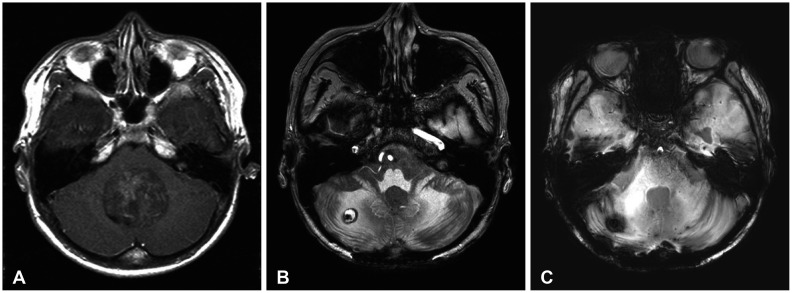 Radiation-Induced Cavernous Malformation in the Cerebellum: Clinical Features of Two Cases.