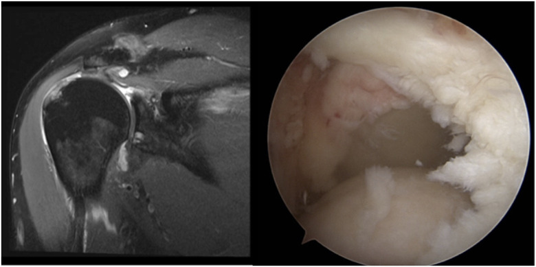 Augmentation Techniques for Rotator Cuff Repairs.