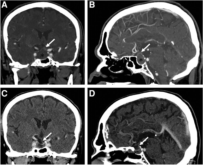 Thyroid-Stimulating Hormone/Growth Hormone Cosecreting Pituitary Adenoma With Normal Thyroid-Stimulating Hormone Level.