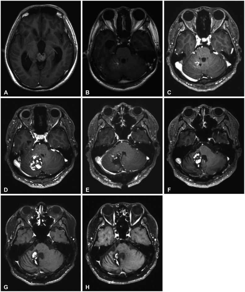 Radiation-Induced Cavernous Malformation in the Cerebellum: Clinical Features of Two Cases.