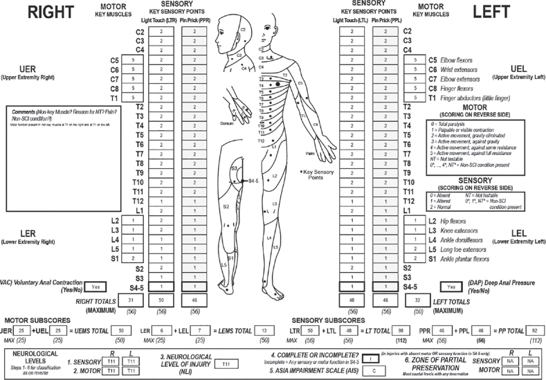 PARAPARESIS FOLLOWING PERIPHERAL AND CENTRAL NERVOUS SYSTEM LESIONS AFTER A LIGHTNING STRIKE - A CASE REPORT.