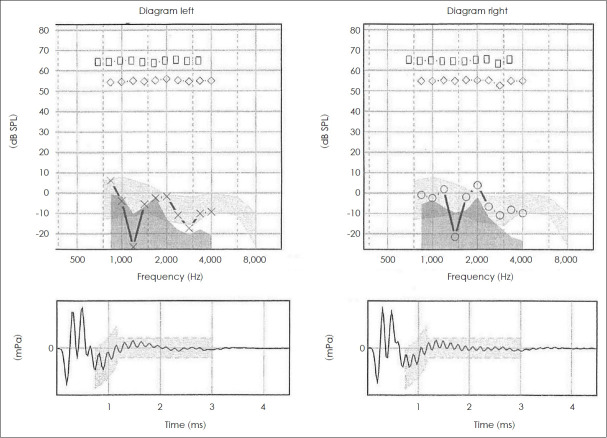 Advances in Understanding the Molecular Dynamics of Autosomal Dominant Auditory Neuropathy: Unveiling a Novel DIAPH3 Gene Variant Associated With Sensorineural Hearing Loss and Bilateral Vestibular Aqueduct Enlargement.