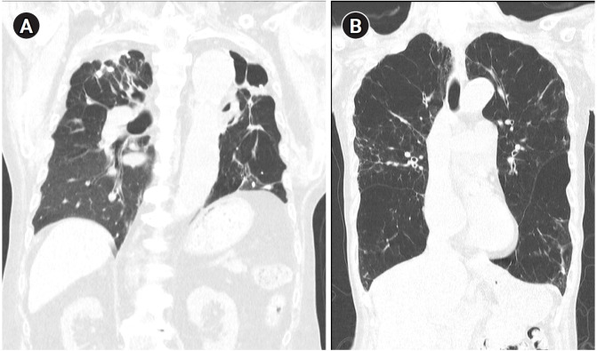 Pathophysiology, clinical manifestation, and treatment of tuberculosis-associated chronic obstructive pulmonary disease: a narrative review.