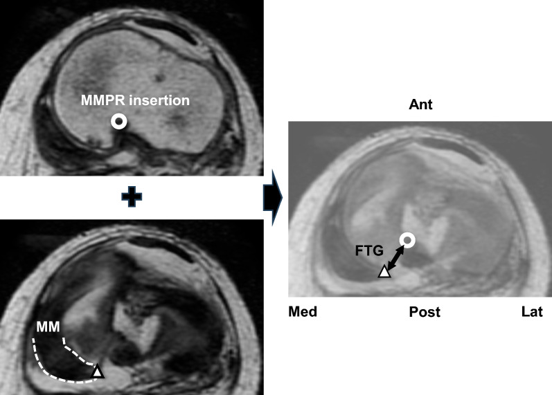 The preoperative flexion tear gap affects postoperative meniscus stability after pullout repair for medial meniscus posterior root tear.