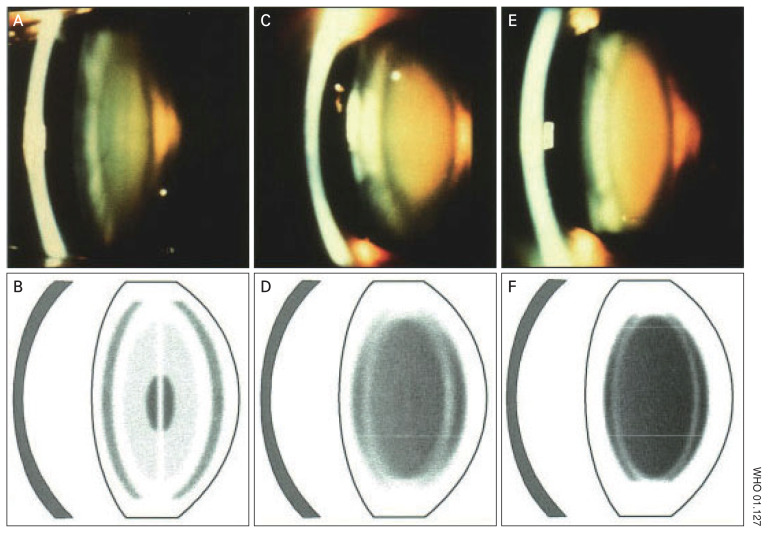 Reliability and Accuracy of Smart Eye Camera in Determining Grading of Nuclear Cataract.