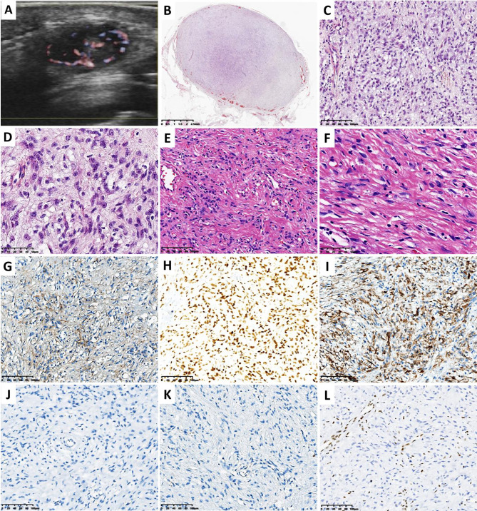 Pathologic and genomic characteristics of myoepithelioma-like tumor of the vulvar region: three case reports.