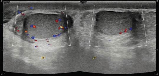 Acute Scrotal Pain - Role of Sonographic Evaluation in Solving Diagnostic Dilemma.