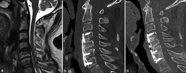 Contiguous versus skip discectomy and fusion in cervical disc herniation: Do we need to fuse the normal intermediate segment?