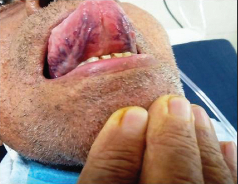 Comparative analysis of oral manifestations of Covid 19.