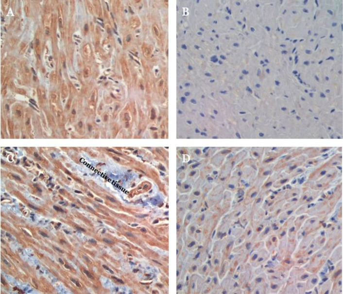 Effect of the modified Atkins diet on NLRP3, caspase-1, IL-ιβ, and IL-10 in patients with tetralogy of Fallot undergoing open-heart surgery: A randomized controlled trial.
