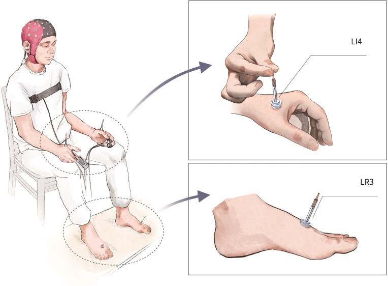 Acupuncture effects on emotional reactivity of youth with self-reported depressive symptoms.