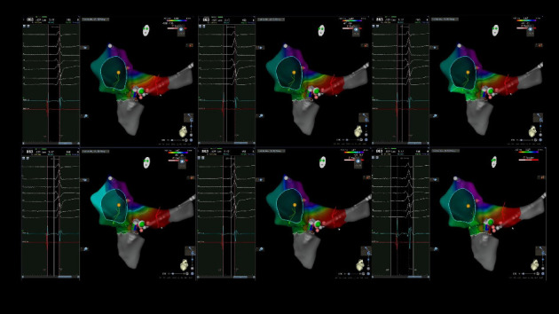A 29-Year-Old Man With Type 2 Hermansky-Pudlak Syndrome and Wolff-Parkinson-White Syndrome: The Hypothesis of a Potential Link Between These Two Conditions.