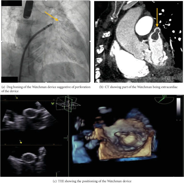Less Is More: Management of Left Atrial Appendage Perforation With Impending Cardiac Tamponade Following Watchman Device Placement.
