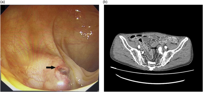 Massive lower gastrointestinal hemorrhage due to primary internal iliac arterial-sigmoid colon fistula.
