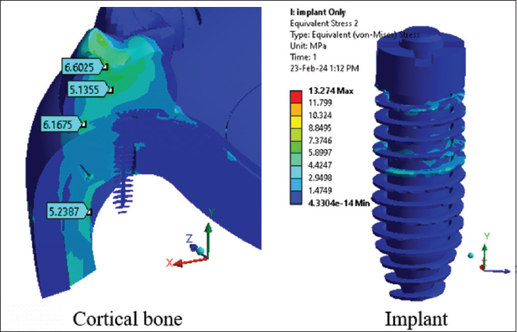 Effectiveness of the implant stabilizing plate on the stress distribution around the implant placed immediately after maxillary sinus lifting: A finite element study.