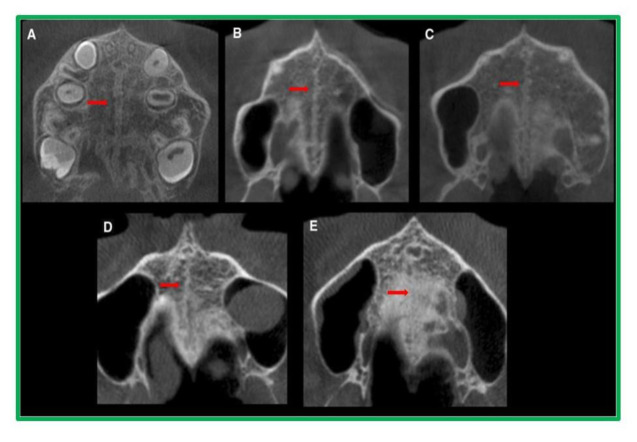 Evaluation of Mid-Palatal Suture Maturation Stage in Adolescents and Adults Using Cone Beam Computed Tomography (CBCT)- A Comparative Study.