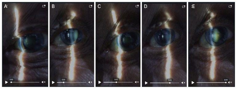 Reliability and Accuracy of Smart Eye Camera in Determining Grading of Nuclear Cataract.
