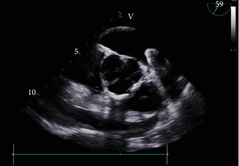 Less Is More: Management of Left Atrial Appendage Perforation With Impending Cardiac Tamponade Following Watchman Device Placement.