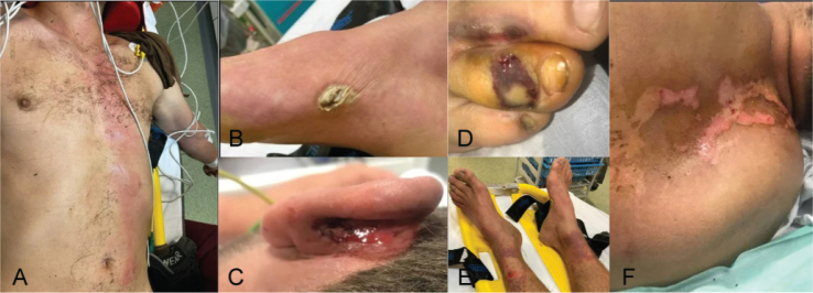 PARAPARESIS FOLLOWING PERIPHERAL AND CENTRAL NERVOUS SYSTEM LESIONS AFTER A LIGHTNING STRIKE - A CASE REPORT.