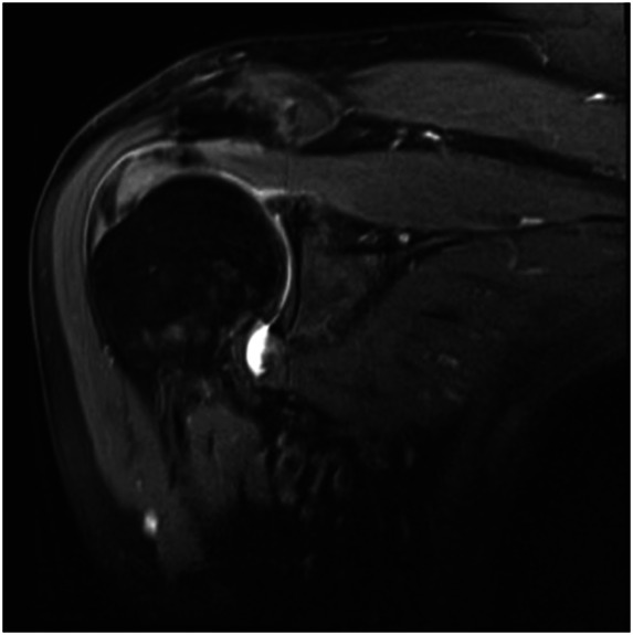 Augmentation Techniques for Rotator Cuff Repairs.