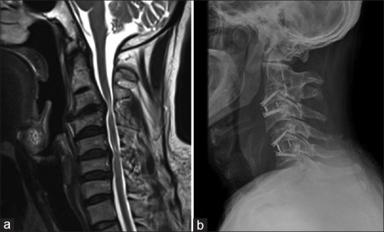 Contiguous versus skip discectomy and fusion in cervical disc herniation: Do we need to fuse the normal intermediate segment?