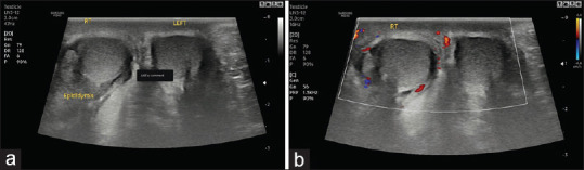 Acute Scrotal Pain - Role of Sonographic Evaluation in Solving Diagnostic Dilemma.