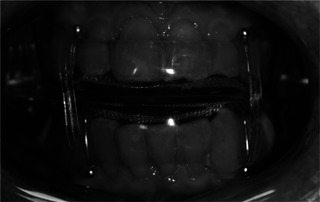 Prediction of non-responders to oral appliance treatment of obstructive sleep apnea: a pilot study.