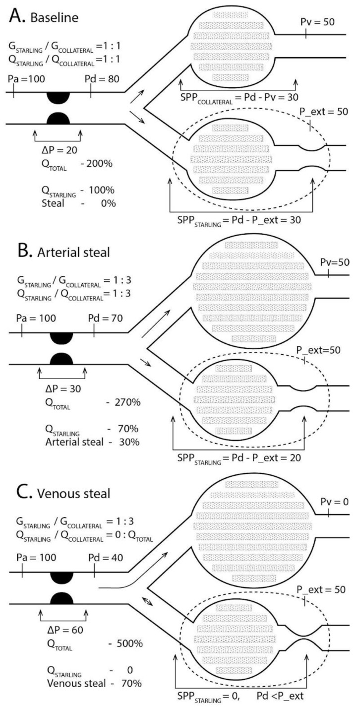 The Concept of Venous Steal: The Impact of Vascular Stenosis and Outflow Pressure Gradient on Blood Flow Diversion.