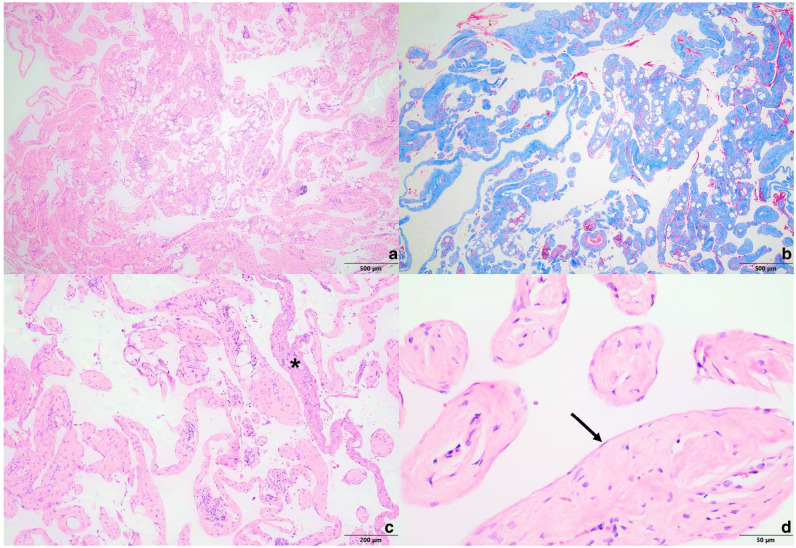 Mesenteric lymphatic malformation with chylothorax in a cat.