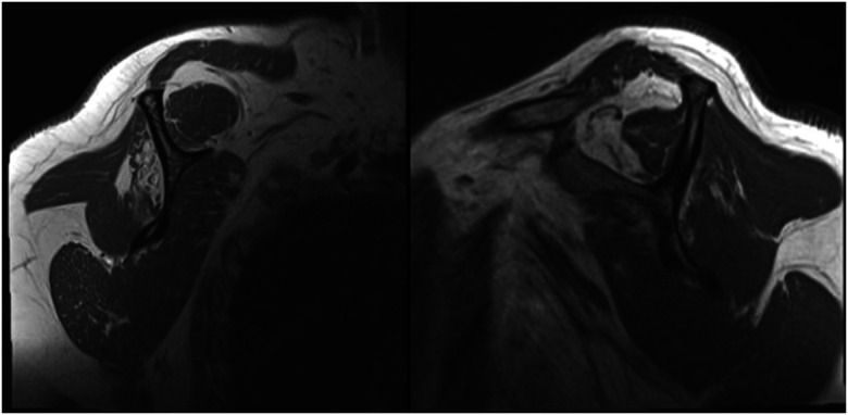Augmentation Techniques for Rotator Cuff Repairs.