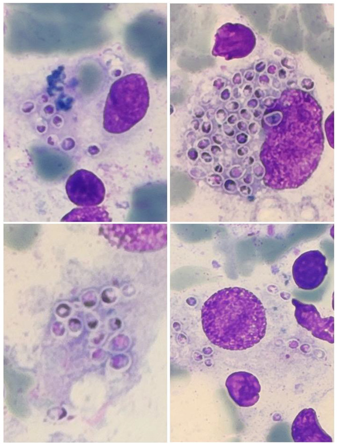 Disseminated histoplasmosis with bone marrow infiltration in a newly diagnosed HIV patient.