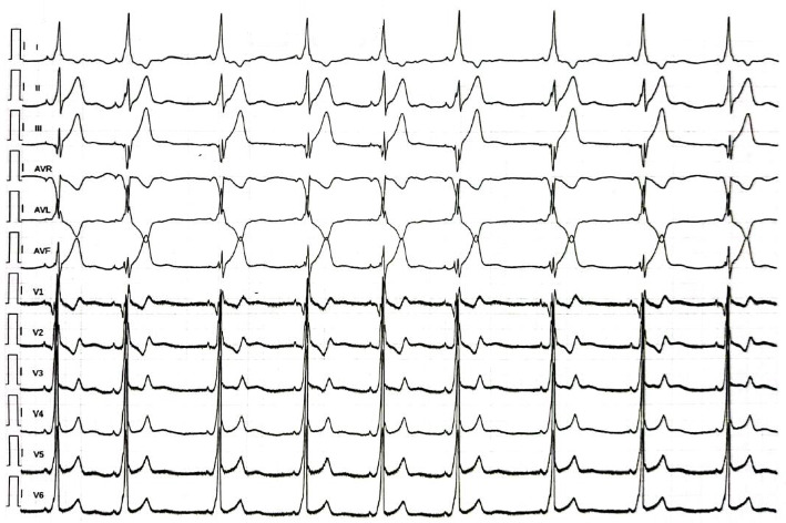 A 29-Year-Old Man With Type 2 Hermansky-Pudlak Syndrome and Wolff-Parkinson-White Syndrome: The Hypothesis of a Potential Link Between These Two Conditions.