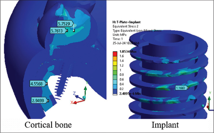 Effectiveness of the implant stabilizing plate on the stress distribution around the implant placed immediately after maxillary sinus lifting: A finite element study.