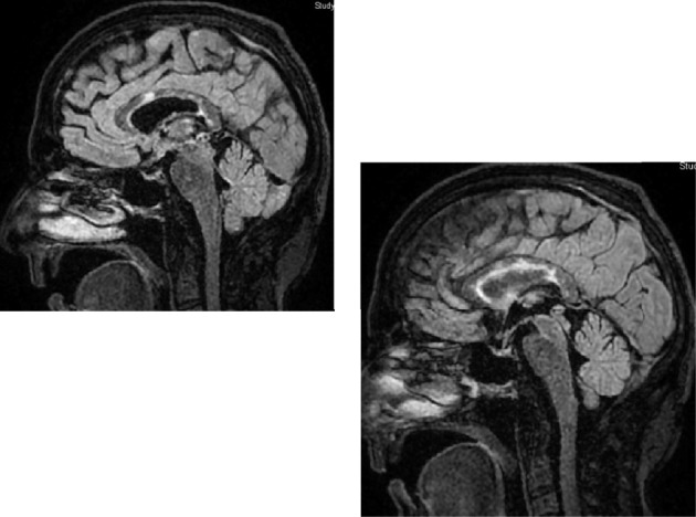 Atypical Presentation of Susac Syndrome in 55-Year-Old: From Unremarkable Stroke Workup to Rapid Diagnosis of "Snowball Strokes" and Successful Immunosuppressive Treatment.