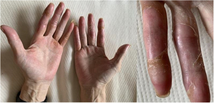 Management of Regorafenib-Induced Hand-Foot Skin Reaction with Topical Chinese Medicine and Urea Ointment: A Case Report and Literature Review.