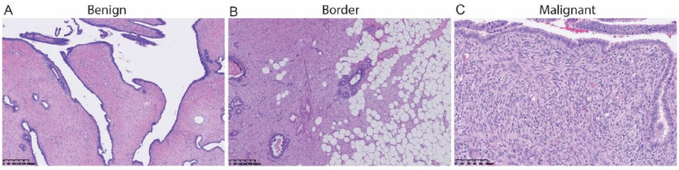 A Comparative Study on Copy Number Variation in Subtypes of Breast Phyllodes Tumors.