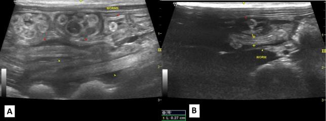 <i>Ascaris lumbricoides</i> infection in captive black sakis (<i>Chiroptes utahickae</i>): a case report and implications for zoonotic transmission.