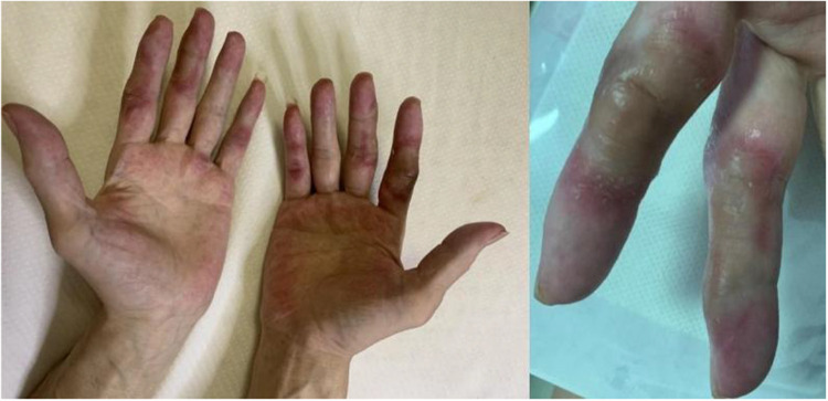 Management of Regorafenib-Induced Hand-Foot Skin Reaction with Topical Chinese Medicine and Urea Ointment: A Case Report and Literature Review.