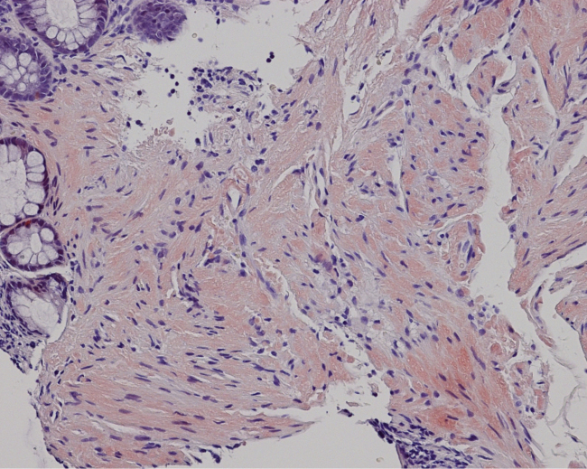 Periorbital Purpura as a Key Diagnostic Clue in Immunoglobulin Light Chain Amyloidosis.
