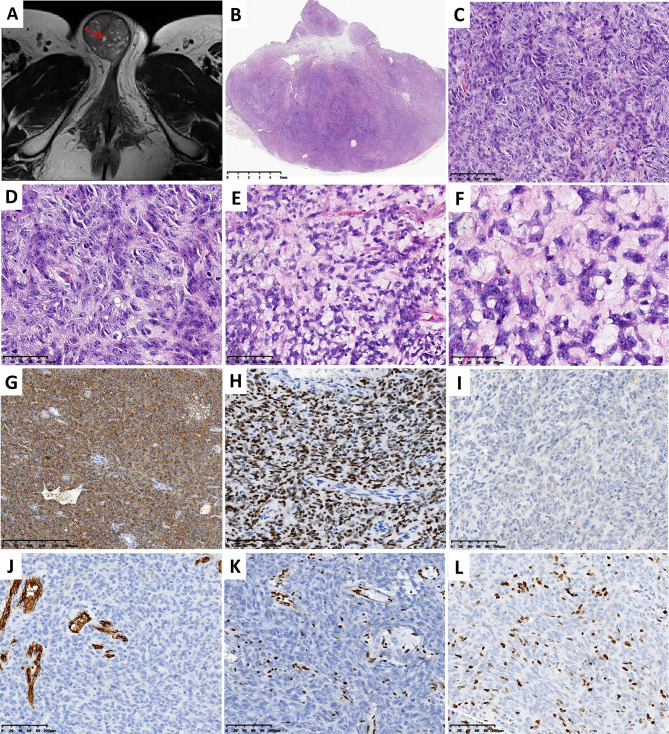 Pathologic and genomic characteristics of myoepithelioma-like tumor of the vulvar region: three case reports.