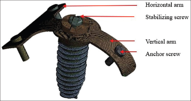 Effectiveness of the implant stabilizing plate on the stress distribution around the implant placed immediately after maxillary sinus lifting: A finite element study.