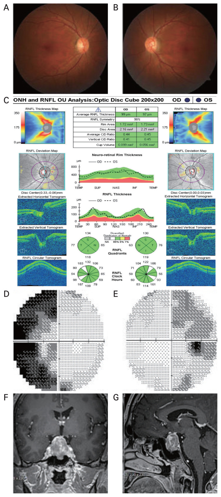 Causes and Clinical Characteristics of Compressive Optic Neuropathy in South Korean Patients.