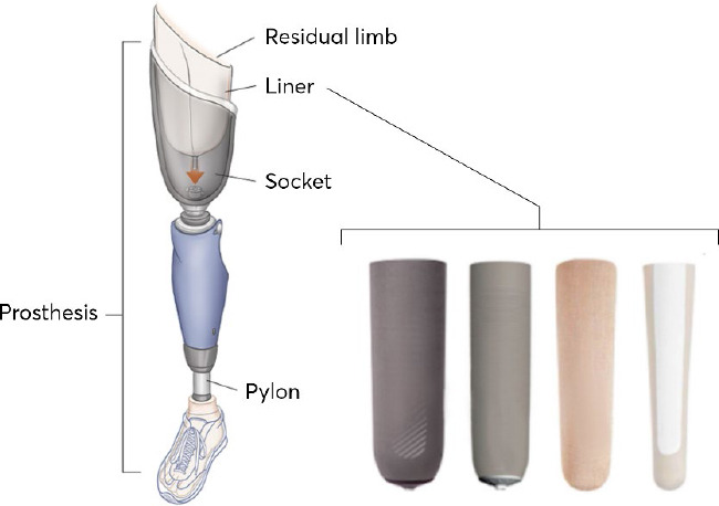 Silver micro- and nanoparticles filled silicone for limb prosthetics.