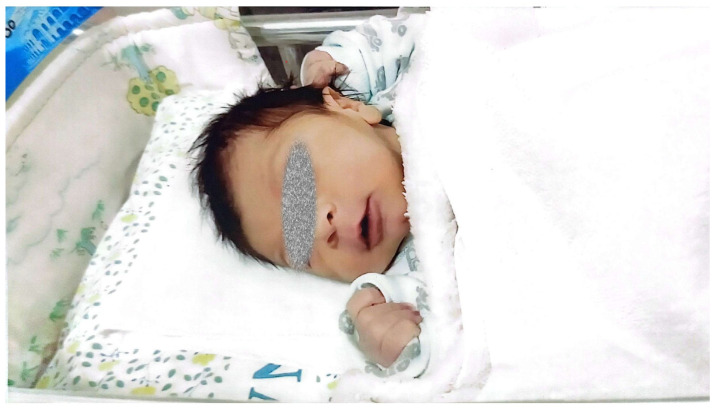 Hemolytic Anemia Due to Gamma-Glutamylcysteine Synthetase Deficiency: A Rare Novel Case in an Arab-Muslim Israeli Child.