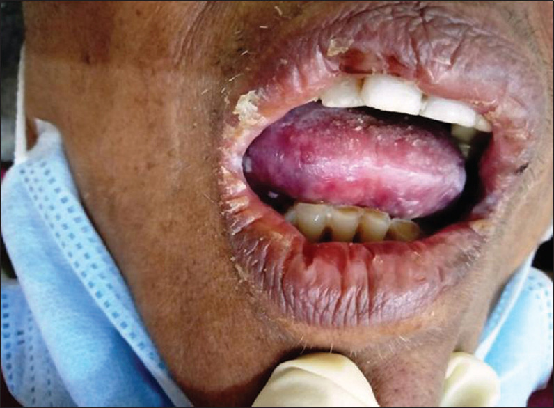 Comparative analysis of oral manifestations of Covid 19.