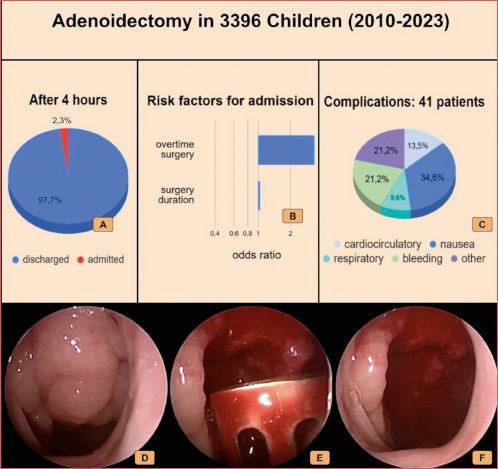 Adenoidectomy as day surgery: feasibility and outcomes.